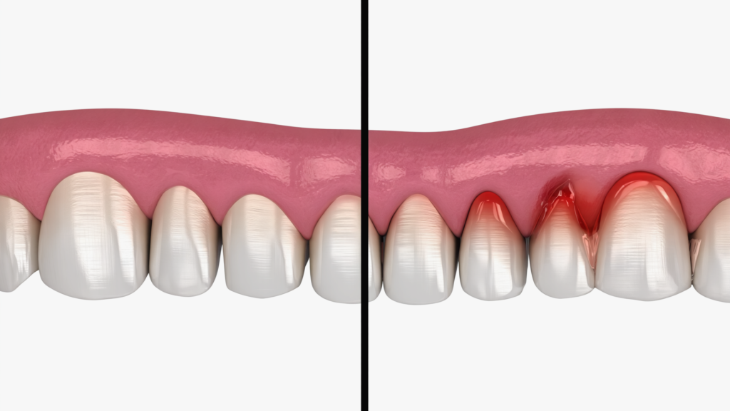 Healthy Teeth Never Bleed – What Your Gums Are Trying to Tell You